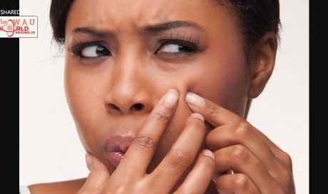 Can Popping Pimples Kill You?