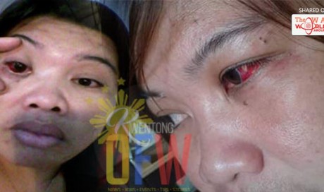 Slapped and Almost Pierced In The Eye; This OFW Suffered So Much In The Hands Of Her Abusive Employer | OFW | WAU