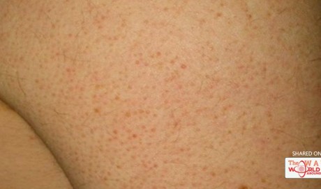 You Have These Tiny Red Pimples On Your Body? Here’s What They Are And Why They Are Dangerous