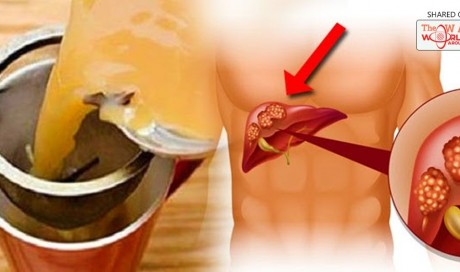 This Tea Dissolves Kidney Stones, Cleanses the Liver, and Kills Cancer Cells
