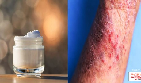 5 Skin-Soothing Tips And Products People With Eczema Swear By