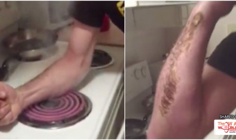 The New ‘Hot Coil Challenge’ Is Literally Scarring People For Life