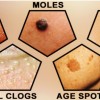 melanoma cancerous skin tags pictures
