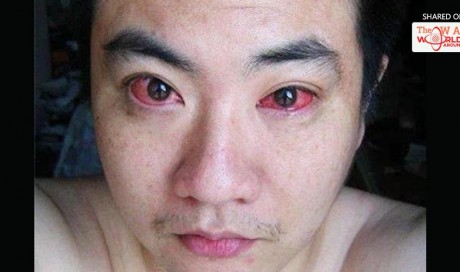 BEWARE! Man Diagnosed With Eye Cancer Because Of Doing This At Night! Most Of Us Doing The Same MISTAKE | Health | Blog | WAU