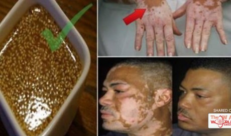 Do You Have This Kind Of White Patches? Doctors Discover Treatment For Vitiligo...... | Blog | Health | WAU