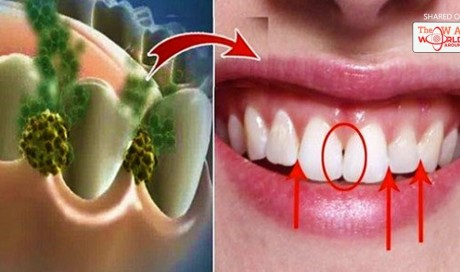 Eliminate Bad Breath In Just 5 Minutes! This Natural Remedy Will Kill All The Bacteria That Cause Bad Breath