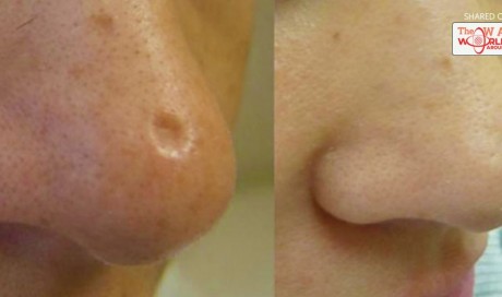 This Homemade Cream Can Eliminate Scars And Refresh The Skin In Just 10 Seconds A Day! | Blog | Health | WAU