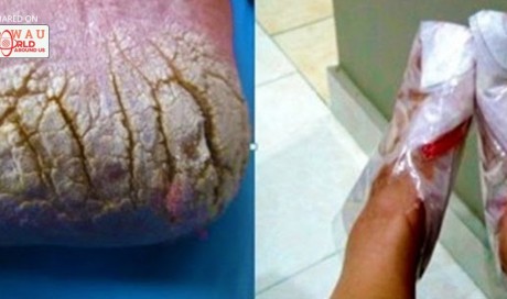 Rub Your Feet With This And Say Goodbye To Cracked Heels, Corns And Varicose Veins In Just 10 Days!