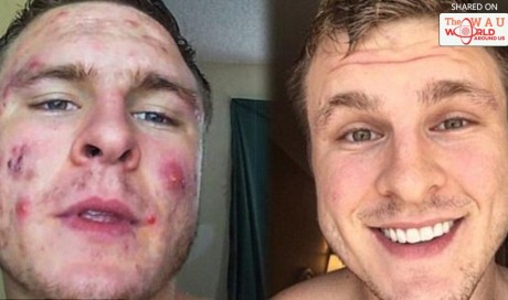 Change your bed sheets EVERY night, never touch your face and shower straight after exercise: Man famed for his incredible acne transformation reveals top tips for clear skin  