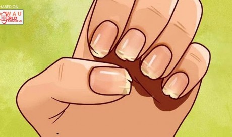 Are Your Nails Always Splitting Or Breaking? Here's What Your Body Is Trying To Tell You