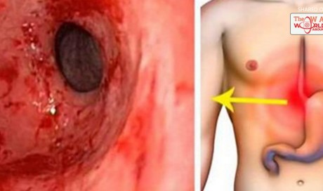 Eliminate Gastritis and Heartburn Forever Using This Effective Remedy That Also Protects Your Intestinal Flora!