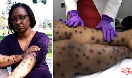 Woman Was Bitten While Mowing Her Lawn By Some Mysterious Insect - Then Round Dots Cover Her Body (Be Aware These Insects Are Maybe In Your Lawn)