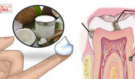 Why Dentists Don't Want To Tell You This? An Easy Way To Fight Cavities With Coconut Oil At Home!