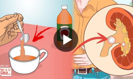 WARNING: Do Not Drink Apple Cider to Flush Out Gall Bladder Stones Without Doing This First!
