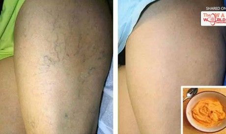 The Most Effective Natural Treatment for Varicose Veins!