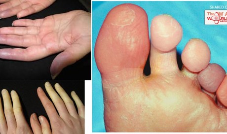9 Warning Reasons Why You Have Cold Hands And Feet, Which Reveal Some Serious Health Problems !!