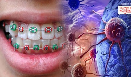 Everyone Who Wears Braces May Suffer From Cancer In 20 Years?