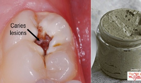Be Your Own Dentist! Heal Cavities, Gum Disease and Whiten Teeth with This Natural Homemade Toothpaste