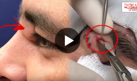 WATCH: A Doctor Pops This Giant Cyst Near This Guy's Eye! What Happened Next Will Change His Life Forever!