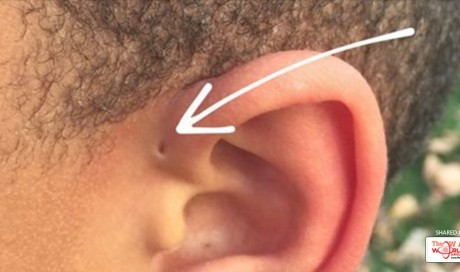Here's Why Some People Have a Tiny Hole Above Their Ears