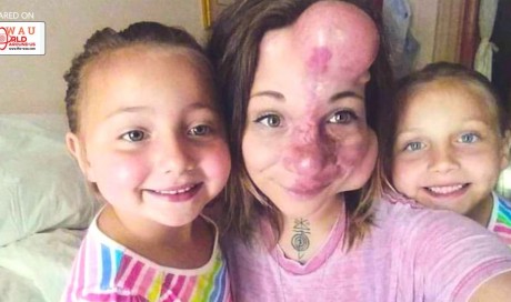 Mom’s Face Is Swollen Where Doctors Put Balloons Under Skin. Years Later She Looks So Different