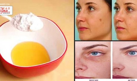 Effective Home Remedies To Eliminate Dark Spots Permanently