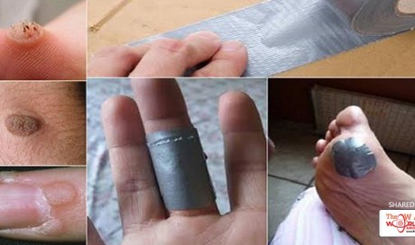 Duct Tape for Removing Warts – This Treatment is Backed by Science