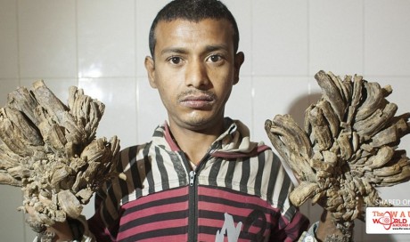 Bangladeshi Tree Man ‘Cured’ of His Branch-like Warts on Hands and Feet
