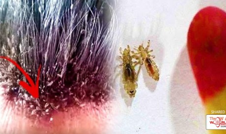 Cheap Hack to Get Rid of Lice That Your Doctor Never Told You About! MUST READ!