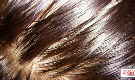 Oily Scalp Causes And Best Treatment For Oily Scalp