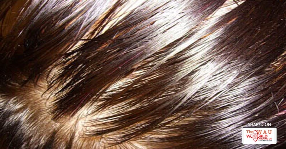 Oily Scalp Causes And Best Treatment For Oily Scalp Blog