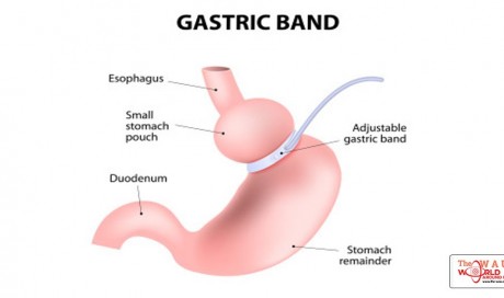 What Is Gastric Banding Surgery for Weight Loss?