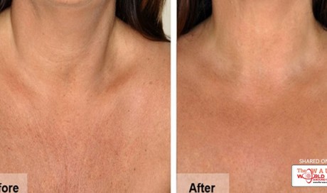 NATURAL REMEDIES TO REDUCE THE WRINKLES O YOUR NECK AND CHEST