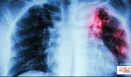 Is Tuberculosis A Dangerous Disease?