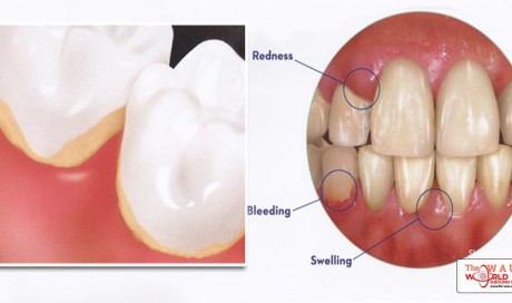 Gingivitis and Periodontal Disease (Gum Disease)
