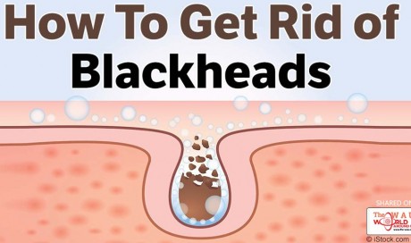 Who Says You Can’t Remove Blackheads Fast and Naturally!
