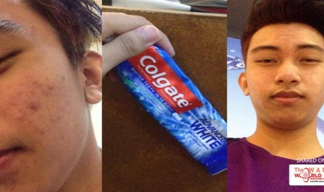 Like Magic: This Man Revealed the Effects of Applying Toothpaste on your Face to Remove Acne! UNBELIEVABLE!