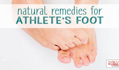 5 Effective Natural Ways to Remedy Athlete’s Foot for Good