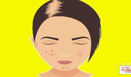 PCOS Acne & Hair Fall Is Treatable! Here’s How You Can Deal With It At Home