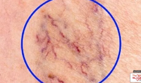 Spider Veins And How To Treat Them