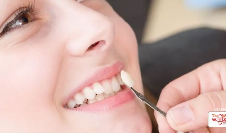 Give your smile an upgrade with dental veneers