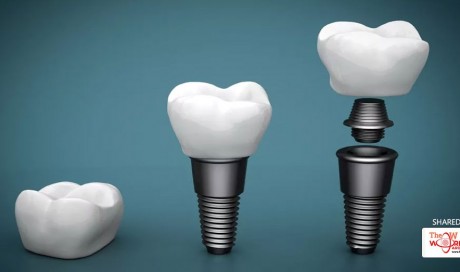 Dental implants, the best solution for your missing teeth