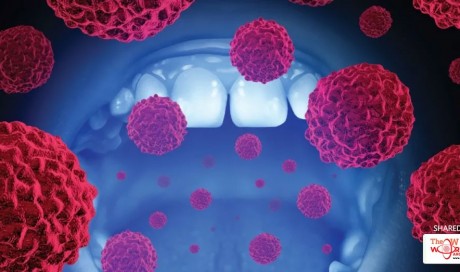 Detecting oral cancer early