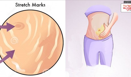 5 Homemade Remedies That Will Help You Remove and Prevent Stretch Marks