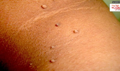 How to Remove Skin Tags on Your Neck Easily at Home