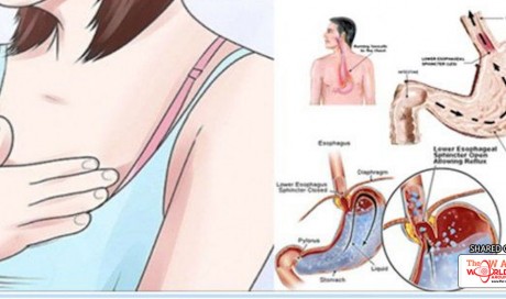 How To Kill Bacteria That Cause Heartburn,Diarrhea, Bloating And Reflux!