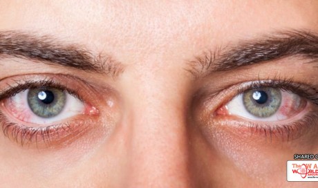 How to Treat Dry Eyes Naturally
