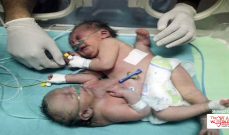 Travel plea for conjoined twins in blockaded Gaza