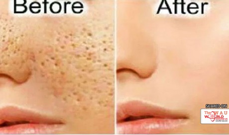 All Open Pores Will Disappear from Your Skin Forever in Just 3 Days!