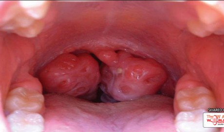 Medical Treatments and Home Remedies for Tonsillitis